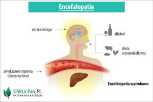 Encefalopatia