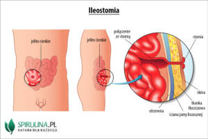 Ileostomia