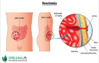 Ileostomia