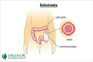 Kolostomia