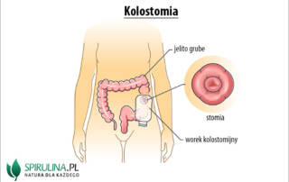 Kolostomia