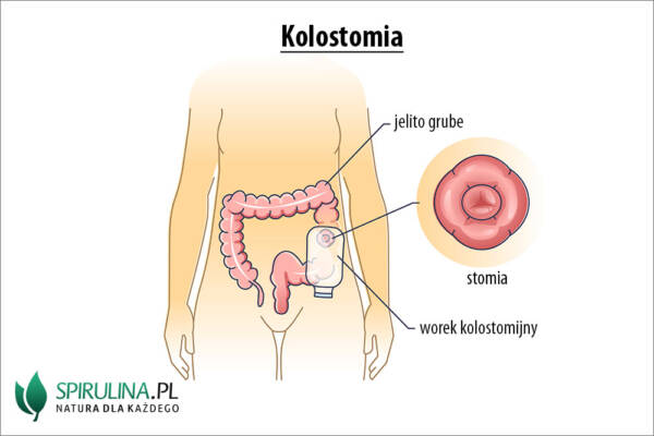 Kolostomia Algi Spirulina I Chlorella kolostomia-algi-spirulina-i-chlorella