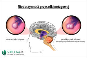 Niedoczynność przysadki mózgowej