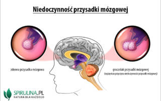 Niedoczynność przysadki mózgowej