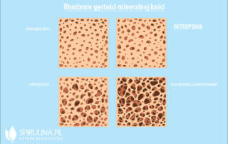 Osteopenia