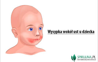 Wysypka wokół ust u dziecka