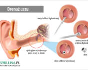 Drenaż uszu