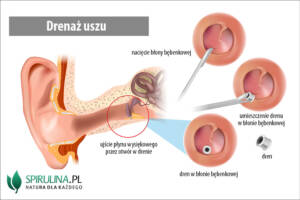 Drenaż uszu