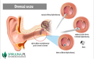 Drenaż uszu