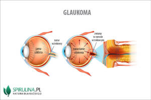 Glaukoma