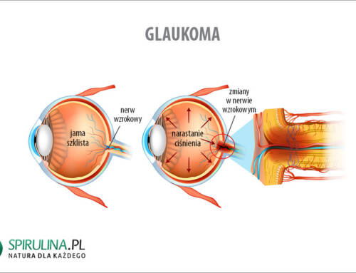 Glaukoma