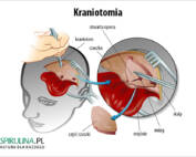 Kraniotomia