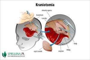 Kraniotomia