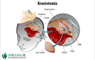 Kraniotomia