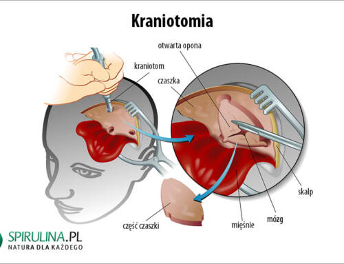 Kraniotomia
