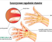 Łuszczycowe zapalenie stawów