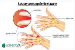 Łuszczycowe zapalenie stawów