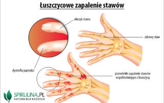 Łuszczycowe zapalenie stawów