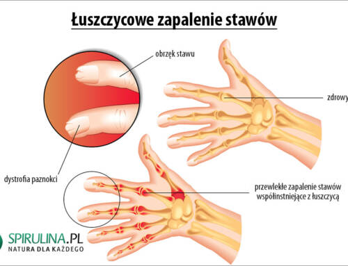 Łuszczycowe zapalenie stawów