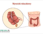 Wyrostek robaczkowy