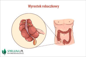 Wyrostek robaczkowy