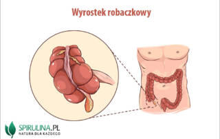 Wyrostek robaczkowy