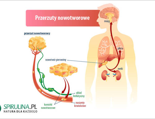 Przerzuty nowotworowe