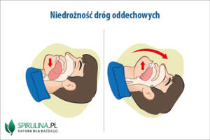 Niedrożność dróg oddechowych