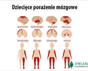 Dziecięce porażenie mózgowe