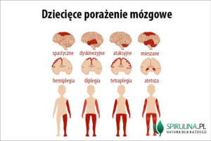 Dziecięce porażenie mózgowe