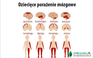 Dziecięce porażenie mózgowe