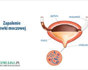 Zapalenie cewki moczowej