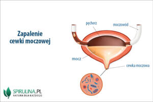 Zapalenie cewki moczowej