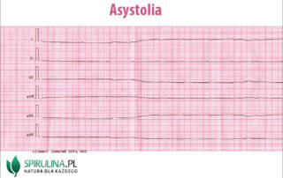 Asystolia