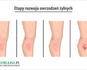 Owrzodzenie żylne