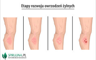 Owrzodzenie żylne