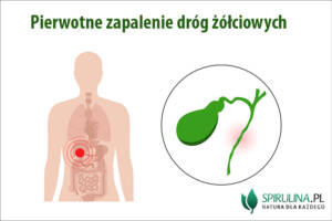 Pierwotne zapalenie dróg żółciowych