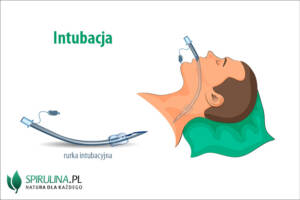 Intubacja