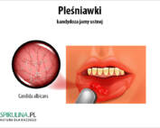 Pleśniawki