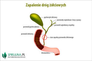 Zapalenie dróg żółciowych