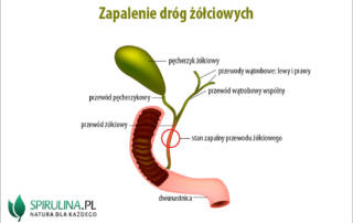 Zapalenie dróg żółciowych