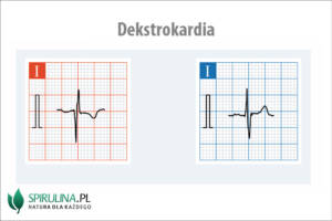 Dekstrokardia