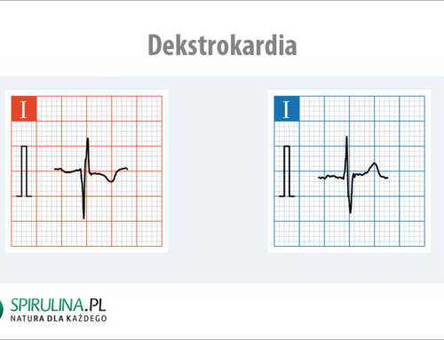Dekstrokardia