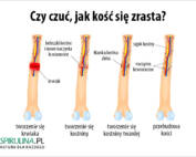 Czy czuć, jak kość się zrasta?