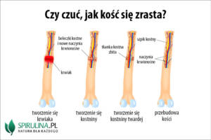 Czy czuć, jak kość się zrasta?