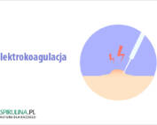 Elektrokoagulacja