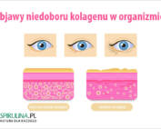 Objawy niedoboru kolagenu w organizmie