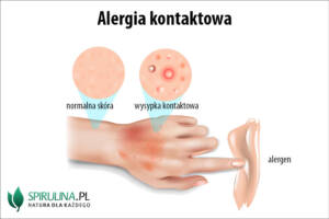 Alergia kontaktowa