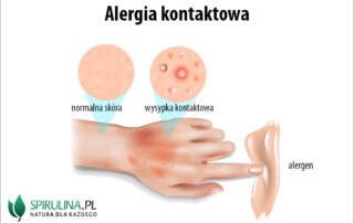 Alergia kontaktowa