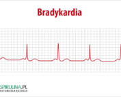 Bradykardia